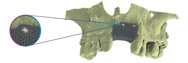 OSTEOSYNTHESIS SCREWS